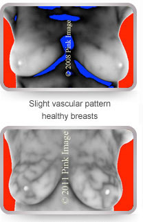 What is Pink Image? Giving Women a Fighting Chance Against Breast Cancer, High Resolution Breast Thermography, Located in San Diego, Southern California, Orange County